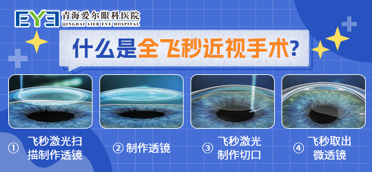 全飞秒近视手术1
