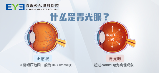 青光眼1
